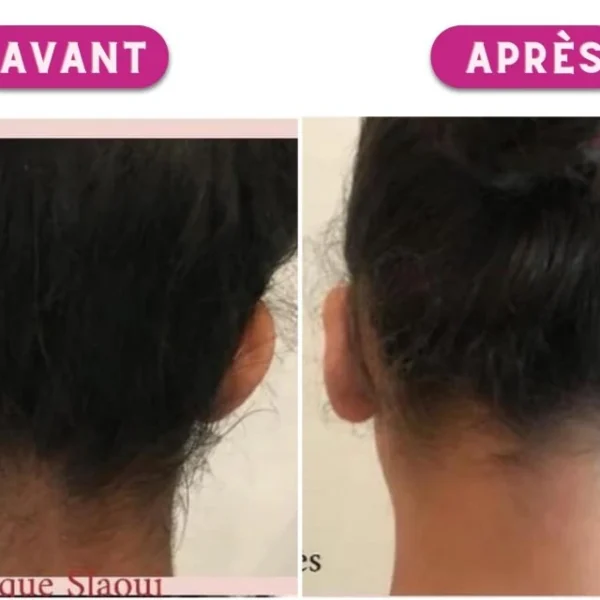 chirurgie des oreilles décollées