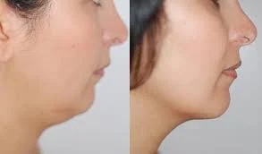 génioplastie d'une femme