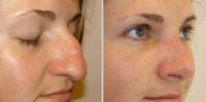 rhinoplastie d'une femme