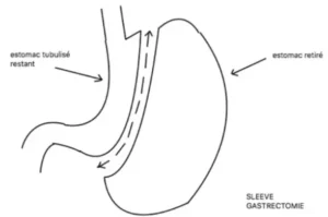 un dessin d'une sleeve gastrique