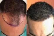 greffe de cheveux